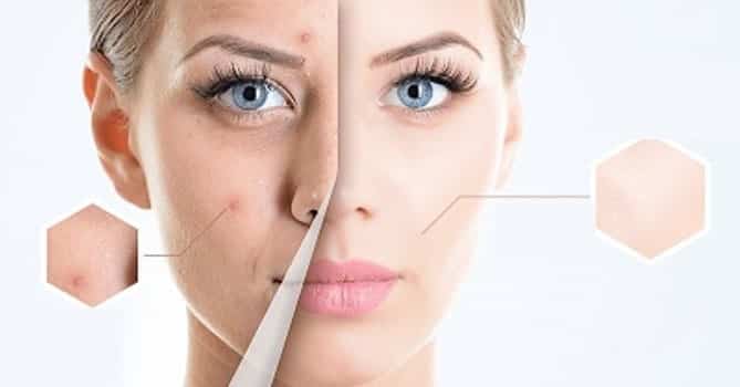 пъпки по лицето